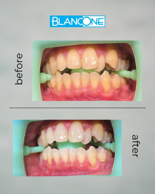 BlancOne® fogfehérítés - a fogfehérítő rendszerek új generációja